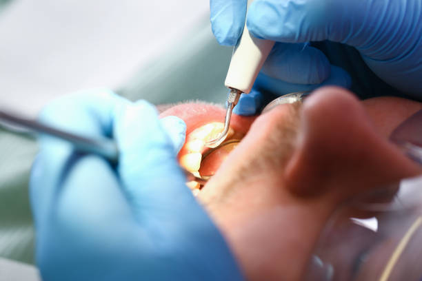 Best Knocked-Out Tooth (Avulsed Tooth) Treatment in Wesley Hills, NY